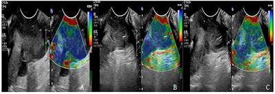 Contrast-enhanced ultrasound combined with elastic imaging for predicting the efficacy of concurrent chemoradiotherapy in cervical cancer: a feasibility study